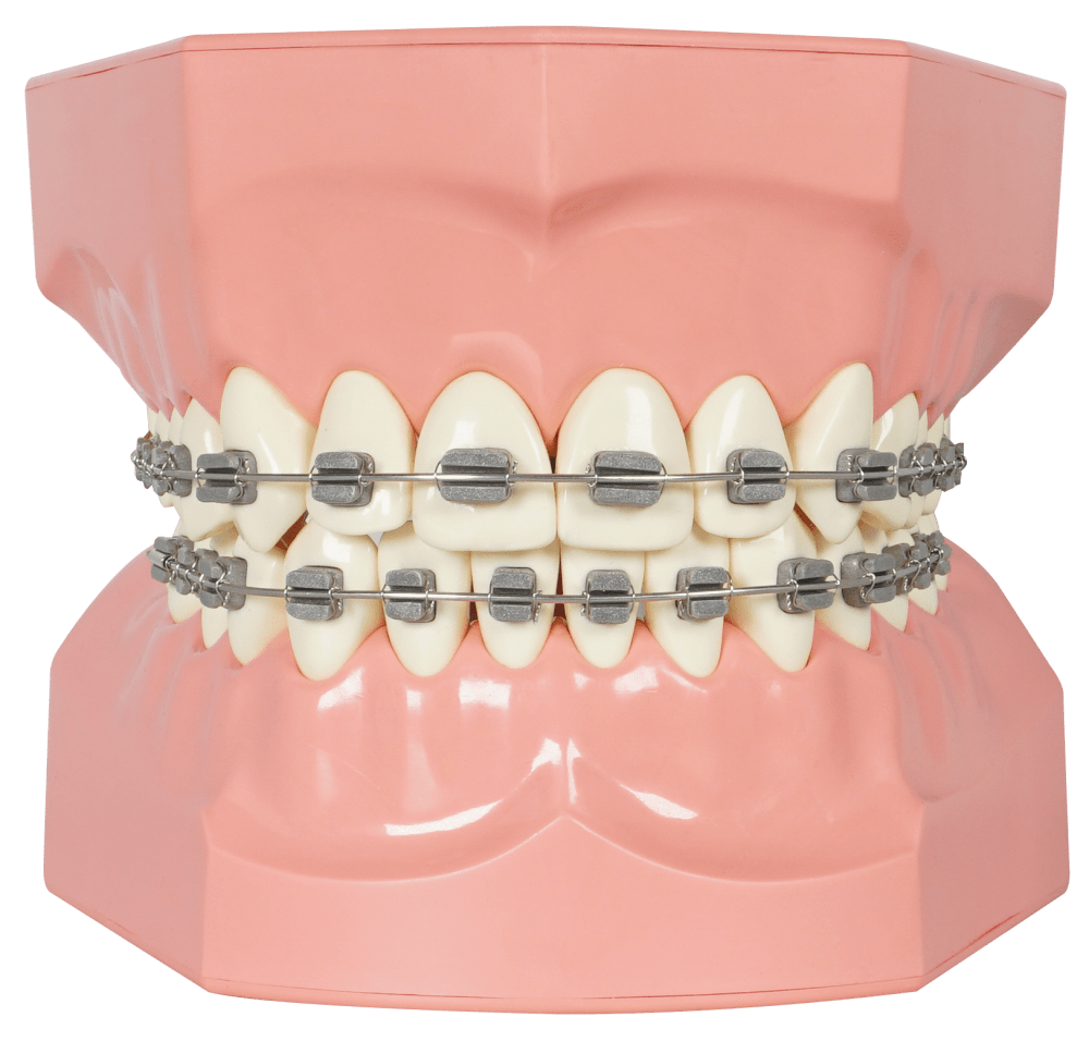 TIPODONTO GIGANTE CON BRACKETS