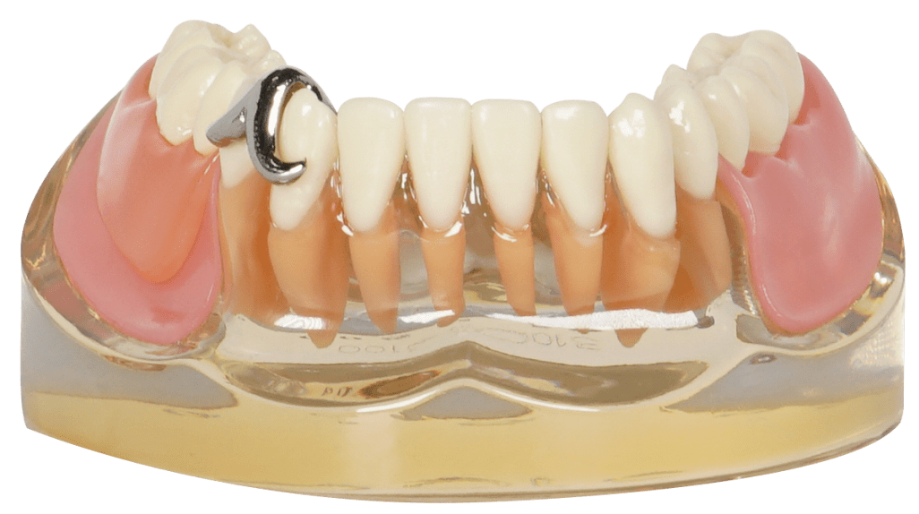 TIPODONTO C/PROTESIS 1ER MOLAR DERE