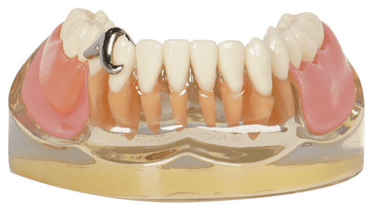 TIPODONTO C/PROTESIS 1ER MOLAR DERE