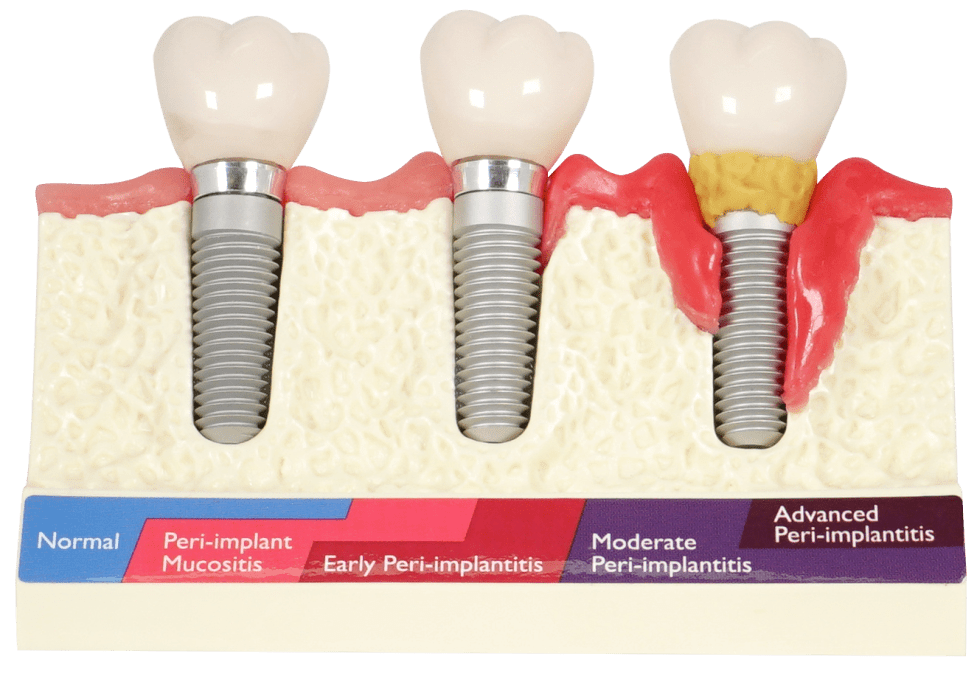 MODELO DE ENFER. PERI-IMPLANTARIA