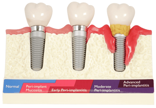 MODELO DE ENFER. PERI-IMPLANTARIA