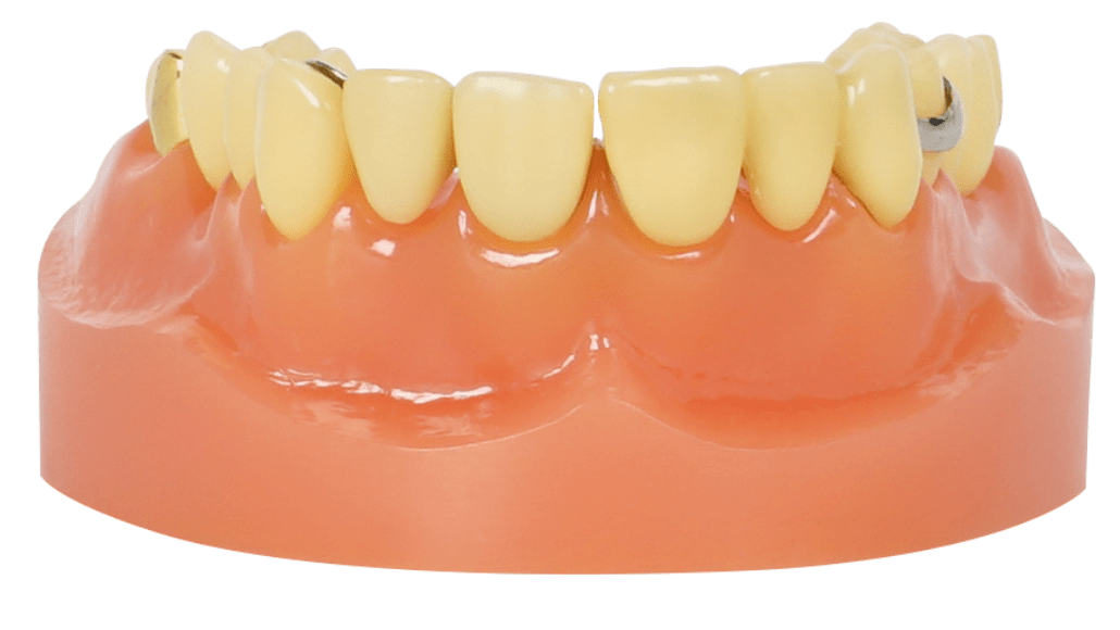 MEDIA ARCADA P/DEMO C/6 O 10 CASOS