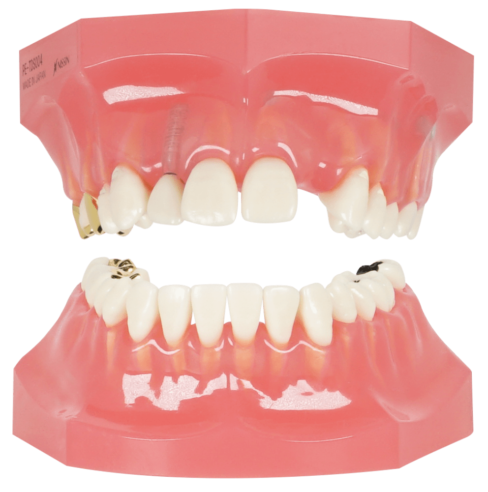 MODELO DE ENFERMEDAD DE DIENTES